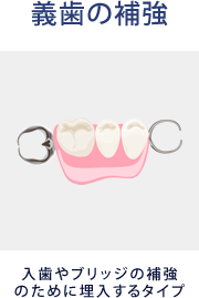 入歯やブリッジの補強のための埋入するタイプ